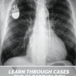 Learn Through Cases CXR In Cardiology
